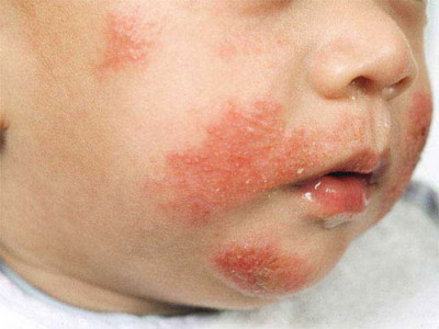 Аллергия у детей: разновидности патологии, провоцирующие факторы и причины возникновения реакции, методы диагностики и лечение заболевания, эффективные профилактические мероприятия