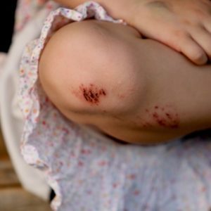 Чем обработать рану у ребенка: правила обработки мелких и крупных ранений, народные и медикаментозные методы лечения, когда стоит обращаться к врачу