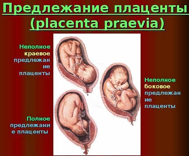 Чем опасно предлежание плаценты: что это такое, провоцирующие факторы и причины патологии, послеродовые осложнения и последствия