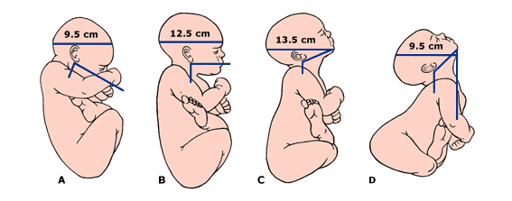 Искусственные роды: показания к процедуре и прогнозы для беременной - Детский доктор