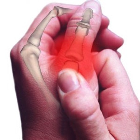 Как определить перелом кисти руки