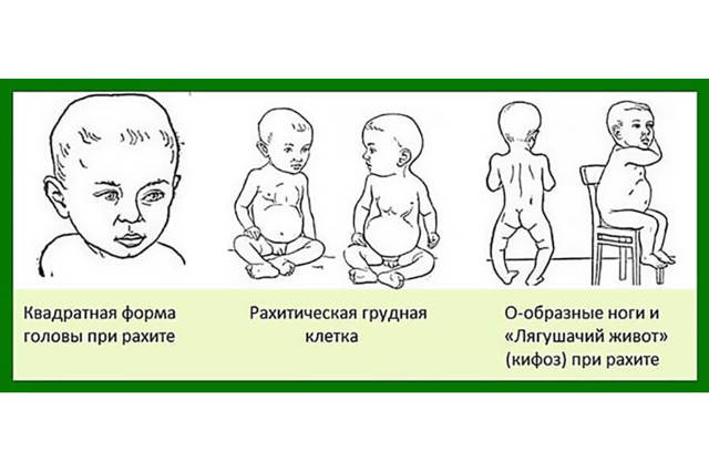 Причины рахита у детей: что это такое, факторы риска возникновения болезни, нерациональное питание ребенка и неблагоприятное течение беременности, патологии новорожденных