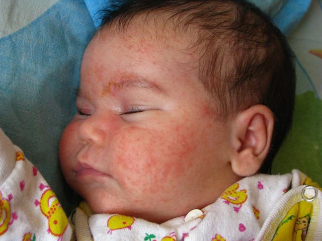 Стафилококк у новорождённых: причины и симптомы заболевания, необходимые анализы и диагностика, лечение в домашних условиях и в стационаре
