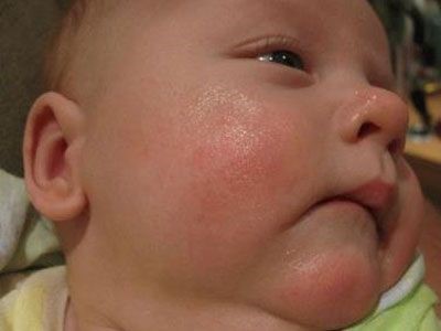 Стафилококк у новорождённых: причины и симптомы заболевания, необходимые анализы и диагностика, лечение в домашних условиях и в стационаре