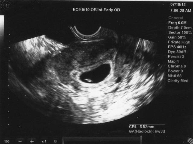 3 неделя беременности: признаки и ощущения матери, необходимость УЗИ и медицинского обследования