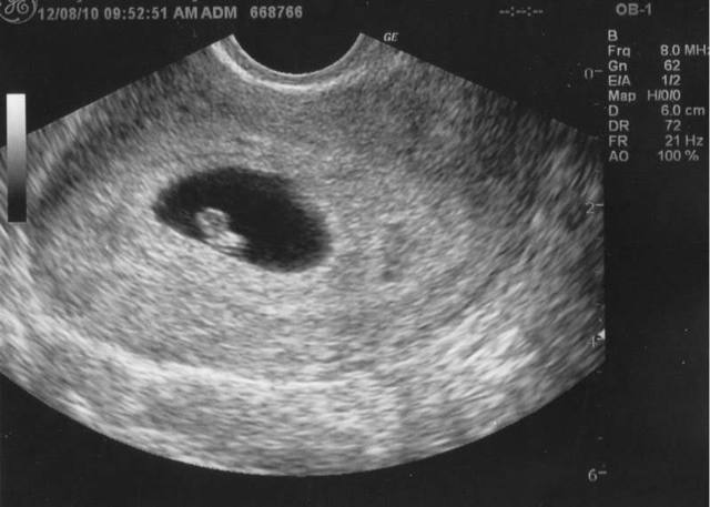 6 неделя беременности: что происходит, узи, выделения, ощущения, плод на 6 неделе