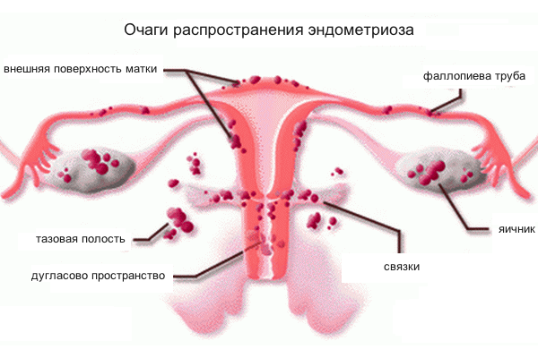 Аденомиоз матки: провоцирующие факторы, характерные признаки, методы обследования и тактика лечения