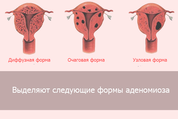 Аденомиоз матки: провоцирующие факторы, характерные признаки, методы обследования и тактика лечения