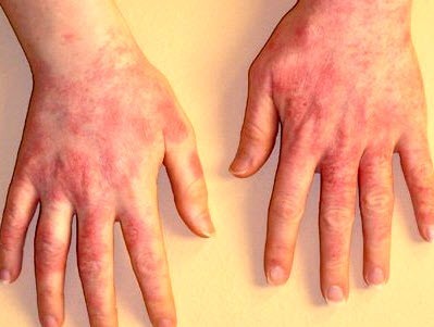 Актинический дерматит на руках, на лице: что это такое и как проявляется, методы лечения и профилактики
