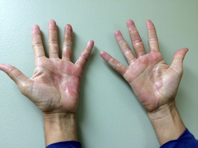 Актинический дерматит на руках, на лице: что это такое и как проявляется, методы лечения и профилактики