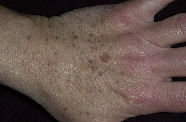 Актинический кератоз кожи: причины образования, сопутствующие симптомы, методы лечения и профилактика