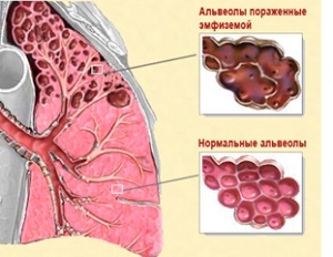 Альвеолит легких: механизм развития и виды заболевания, клинические проявления, методы терапии и прогноз