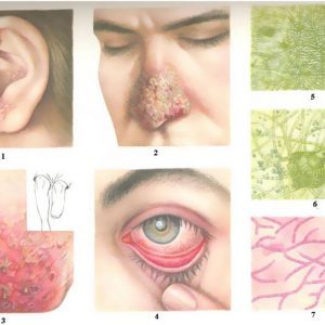 Аллергический бронхолегочный аспергиллез: провоцирующие факторы, клинические проявления, диагностика и тактика лечения