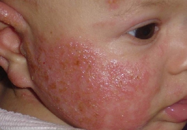 Аллергический дерматит: симптомы и лечение аллергического дерматита у детей и взрослых