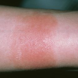 Аллергический дерматит: симптомы и лечение аллергического дерматита у детей и взрослых