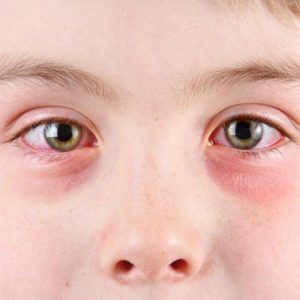 Аллергический кератит: причины возникновения, клиническая картина, лечебные и профилактические мероприятия