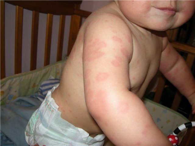 Аллергия на антибиотики: факторы риска, клинические проявления, методы обследования и лечения