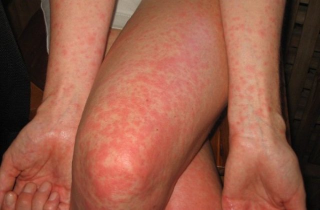Аллергия на антибиотики: факторы риска, клинические проявления, методы обследования и лечения