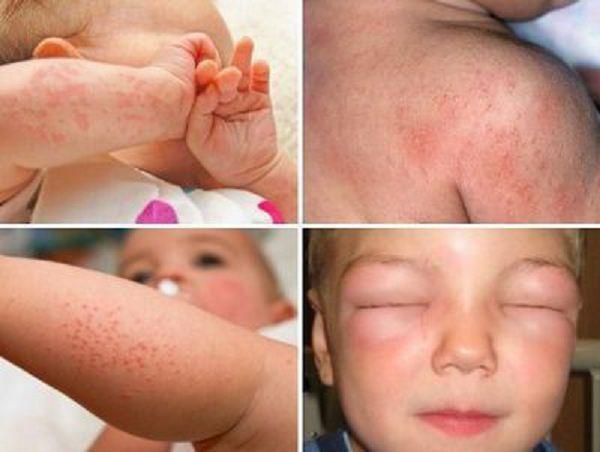 Аллергия на домашних животных: симптомы у взрослых, детей и грудничков, эффективные методы лечения
