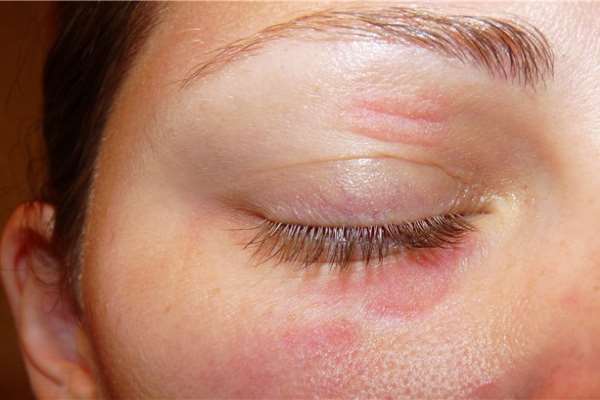Аллергия на косметику на лице, на глазах: сопутствующие симптомы, методы лечения и возможные осложнения