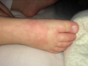 Аллергия на руках и ногах у ребенка: причины появления красных пятен на руках и ногах, лечение аллергии на ногах и руках у ребенка
