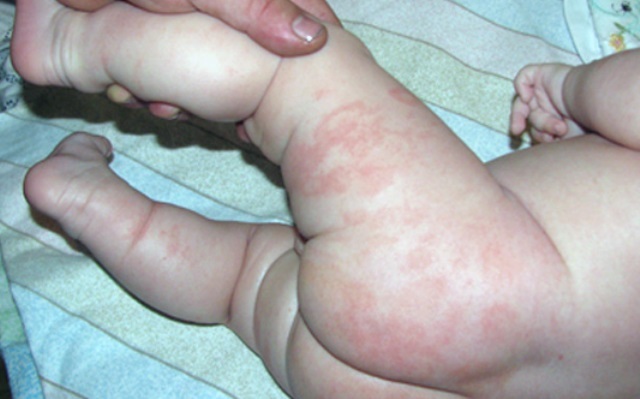 Аллергия на руках и ногах у ребенка: причины появления красных пятен на руках и ногах, лечение аллергии на ногах и руках у ребенка