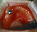 Аллергия на зубной протез в полости рта: причины развития, характерные симптомы, диагностика и тактика лечения