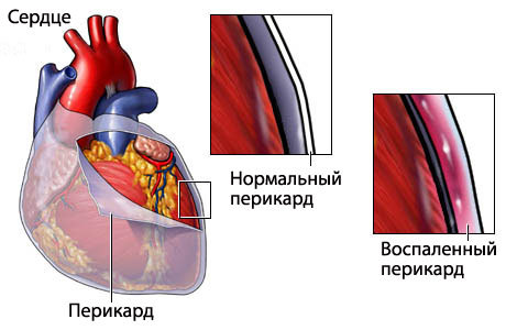 Амилоидоз сердца: провоцирующие факторы, клинические проявления, диагностика и способы лечения