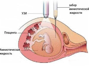 Амниоцентез при беременности: значение исследования, подготовка к анализу, техника проведения процедуры