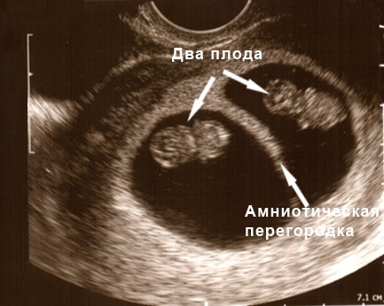 Амниотический тяж при беременности: причины возникновения, методики лечения, последствия для ребенка