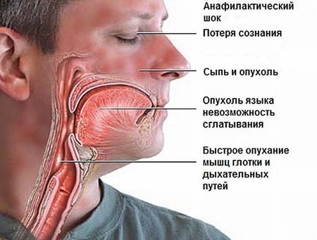 Анафилактический шок: симптомы, причины развития, степени и формы, неотложная помощь при анафилактическом шоке