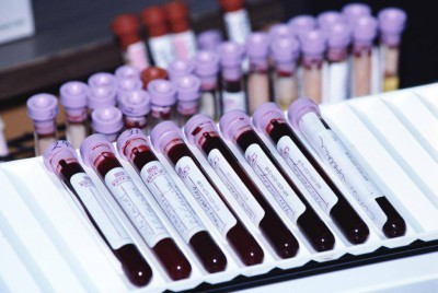 Анализ крови на корь: особенности диагностики, техника проведения, трактовка результата
