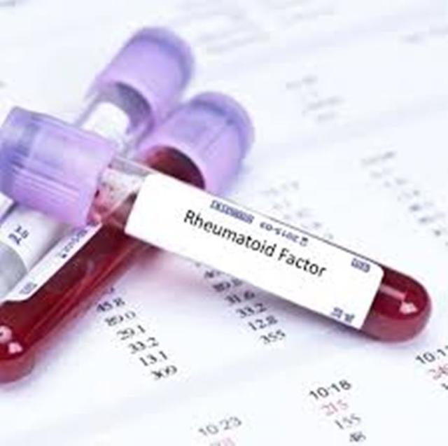 Анализ крови на ревматоидный фактор: особенности исследования, рекомендации по подготовке, расшифровка результатов