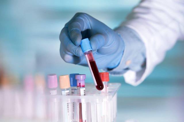 Анализ крови на ревматоидный фактор: особенности исследования, рекомендации по подготовке, расшифровка результатов