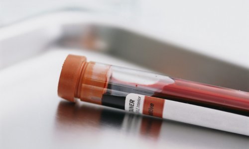 Анализ крови на туберкулез: разновидности диагностики, показания и противопоказания, особенности проведения