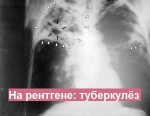 Анализ крови на туберкулез вместо Манту: виды тестов, техника проведения, подготовка к сдаче