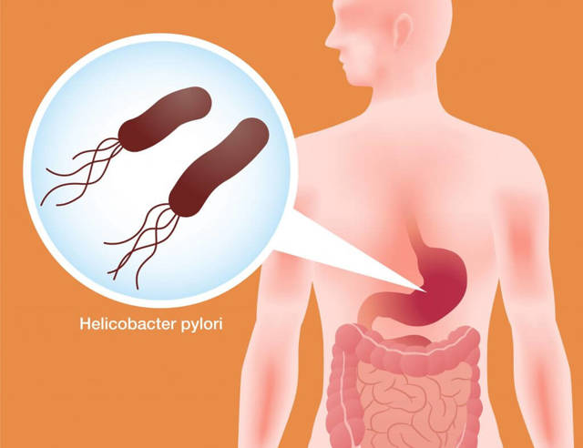 Анализ на Helicobacter Pylori (Хеликобактер Пилори): какие тесты и анализы крови позволяют выявить бактерии?