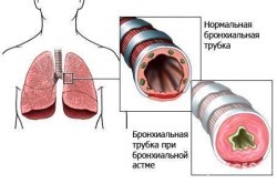 Анализы при бронхиальной астме: подготовительный этап и список необходимых исследований, примеры результатов и их расшифровка, что указывает на болезнь