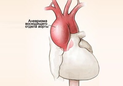 Аневризма аорты: механизм развития, клинические признаки, методы обследований и лечения