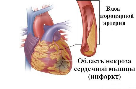 Аневризма сердца: провоцирующие факторы, основные признаки, способы лечения и возможные осложнения