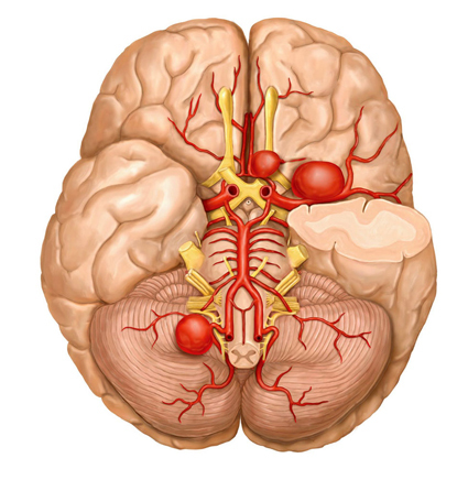 Аневризма сосудов головного мозга: симптомы, лечение, операции при аневризме