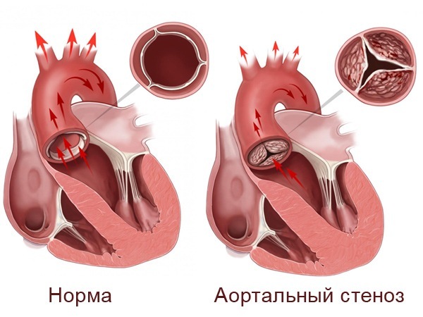 Аортальный стеноз: причины возникновения и симптомы, показания для операции и лечение медикаментами