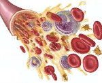 Апластическая анемия: причины заболевания, клинические проявления, диагностика по картине крови и способы лечения