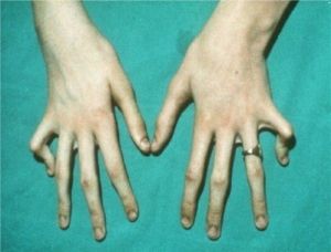 Арахнодактилия, синдром Марфана, болезнь паучьих пальцев: причины развития, типичные признаки, поддерживающая терапия