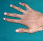 Арахнодактилия, синдром Марфана, болезнь паучьих пальцев: причины развития, типичные признаки, поддерживающая терапия