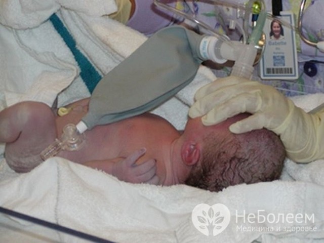 Асфиксия у новорожденного: степени развития, клинические признаки, методы терапии и возможные осложнения