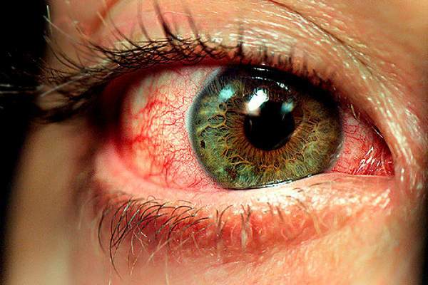 Астенопия, усталость глаз: причины дискомфорта, типичные симптомы, принципы лечения и профилактика
