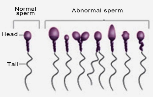 Астенозооспермия: причины и степени патологии, методы терапии, вероятность зачатия