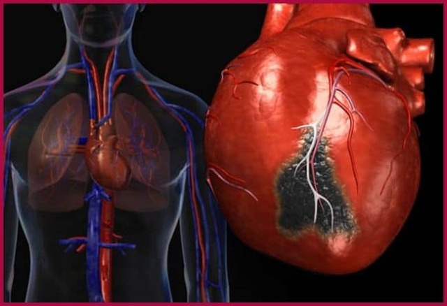 Атипичные формы инфаркта миокарда: виды, симптоматика, неотложная помощь