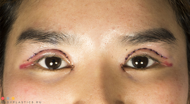 Азиатский разрез глаз: операция, блефаропластика, как изменить разрез глаз